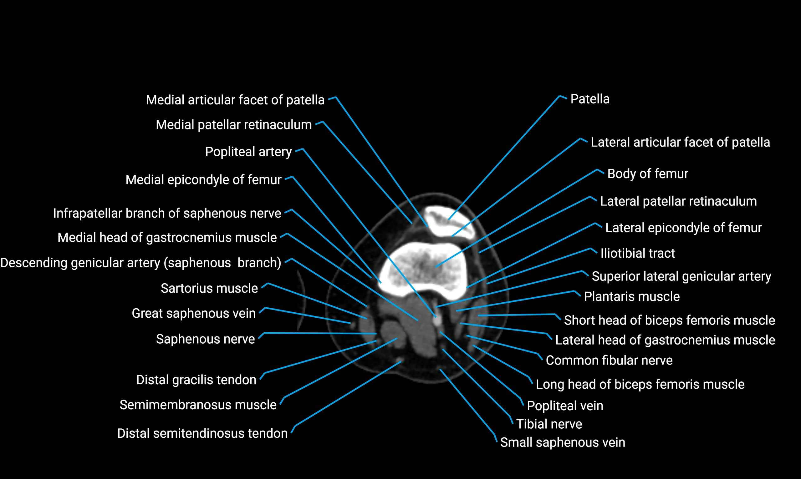CT thigh axial cross sectional anatomy labelled image_82 (2).webp